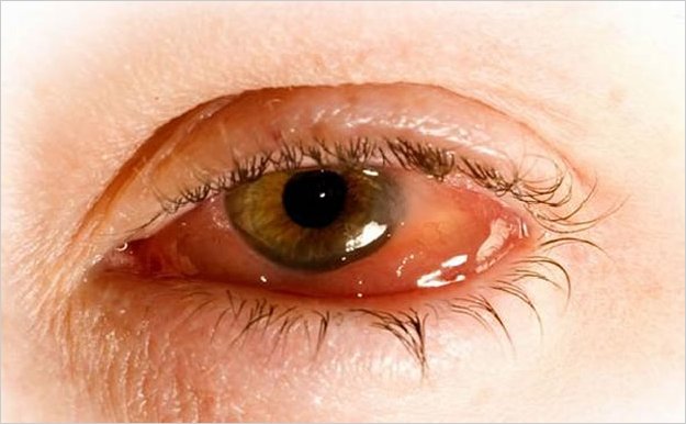 Joven es atacada por el parÃ¡sito que come cÃ³rneas